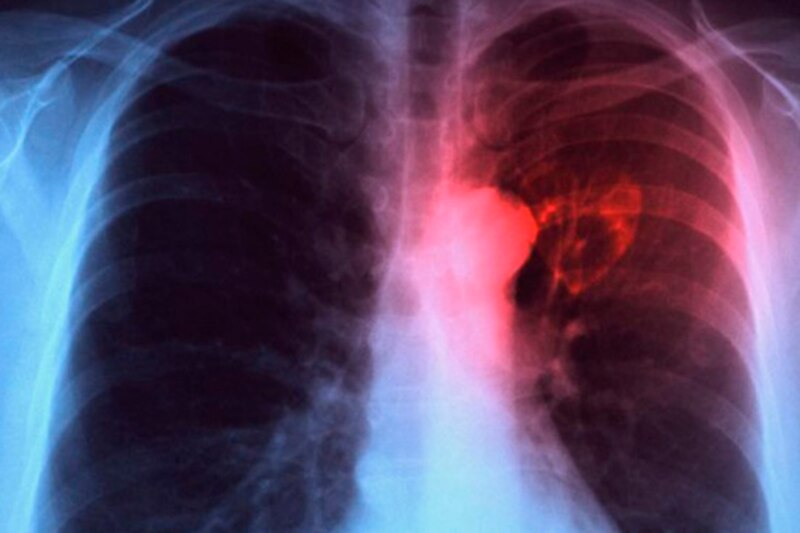 Radiografía de tórax con cáncer de pulmón