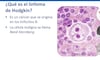 Linfoma de Hodgkin cáncer en la sangre que se manifiesta por crecimiento de ganglios 