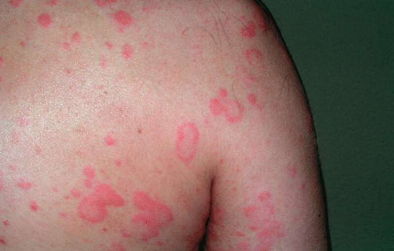 Psoriasis