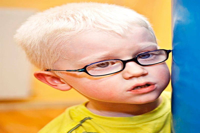 Niño con albinismo
