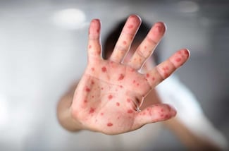 ¿El Mundial del sarampión? Alarma por la negligencia de los antivacunas en EU y el contagio por los viajes masivos 