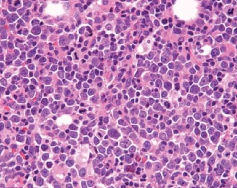 El Linfoma Difuso de Células B Grandes (LDCBG) es un tipo de cáncer agresivo, el cual es el más común de todos los linfomas. En el país se diagnostican 9,000 nuevos casos al año