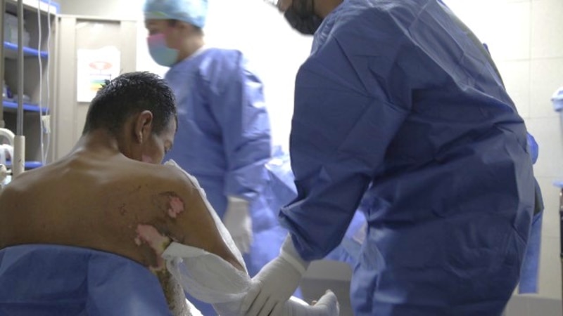 Pacientes con quemaduras de segundo grado son atendidos en IMSS Bienestar Estado de México con plasma rico en plaquetas que mejora su recuperación
