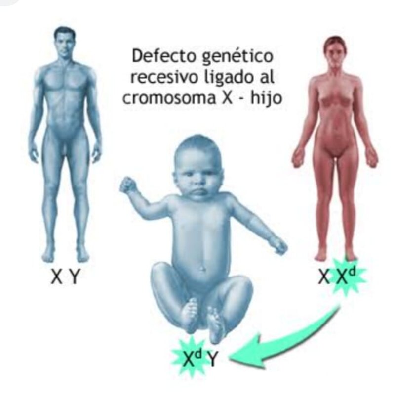 Defecto genético recesivo ligado al cromosoma X