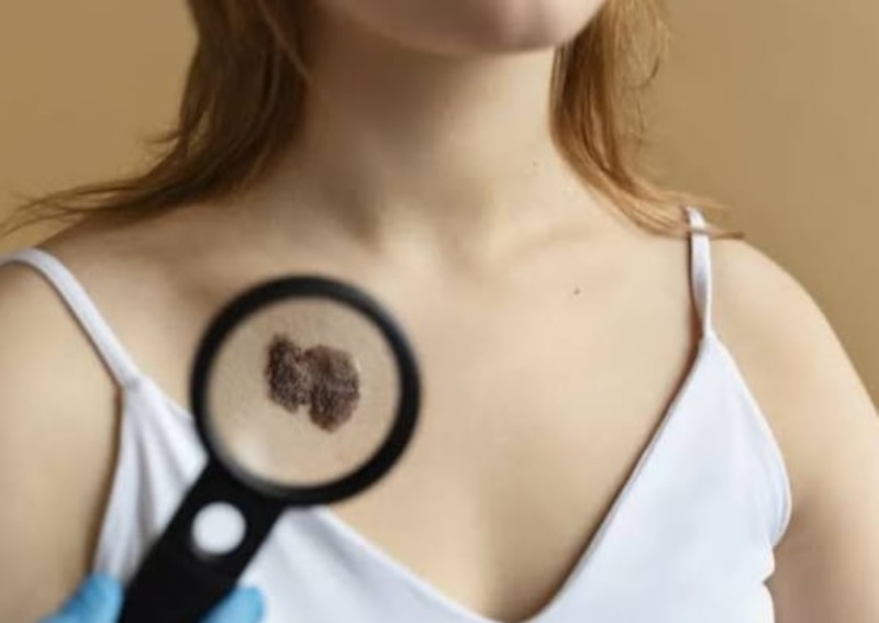 Mujer examinando un lunar en su piel con una lupa