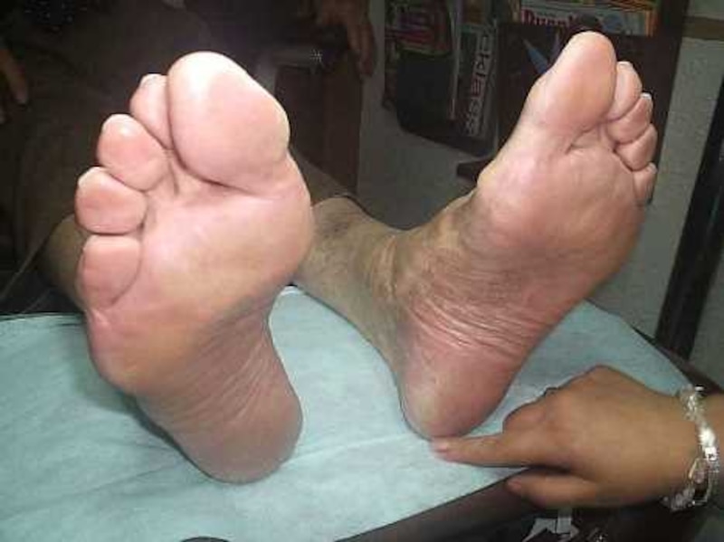 Pies con fascitis plantar