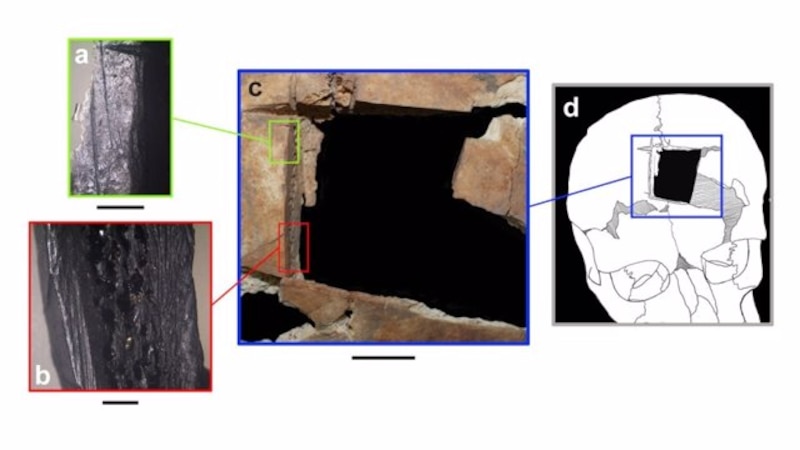 Perforación craneal prehistórica