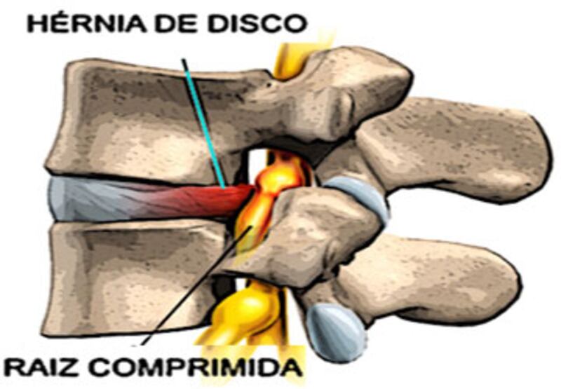 Hernia de disco
