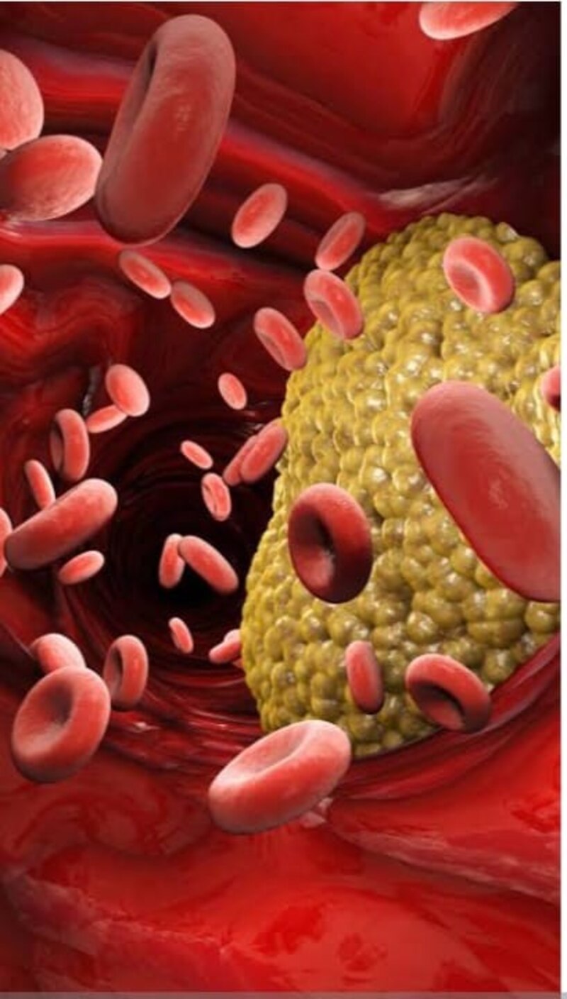 Aterosclerosis