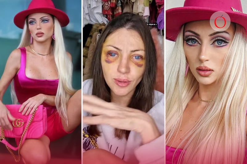 Muere “Barbie humana” tras someterse a más de 27 cirugías estéticas