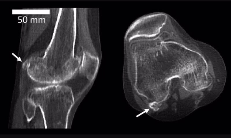 TAC de rodilla