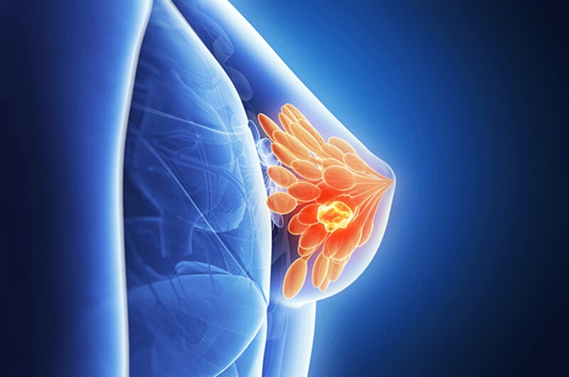 El cáncer de mama es el tipo de cáncer más común en las mujeres.