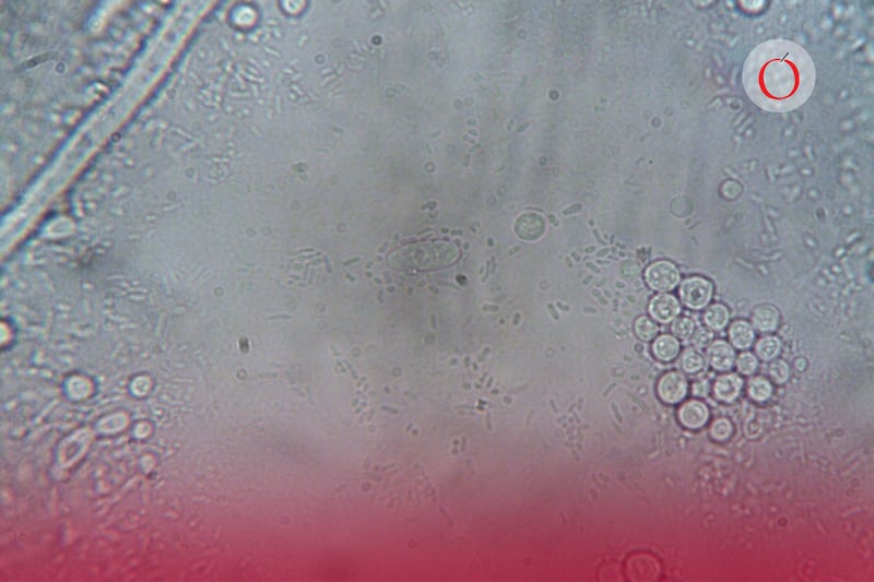 Caso de ciclosporiasis