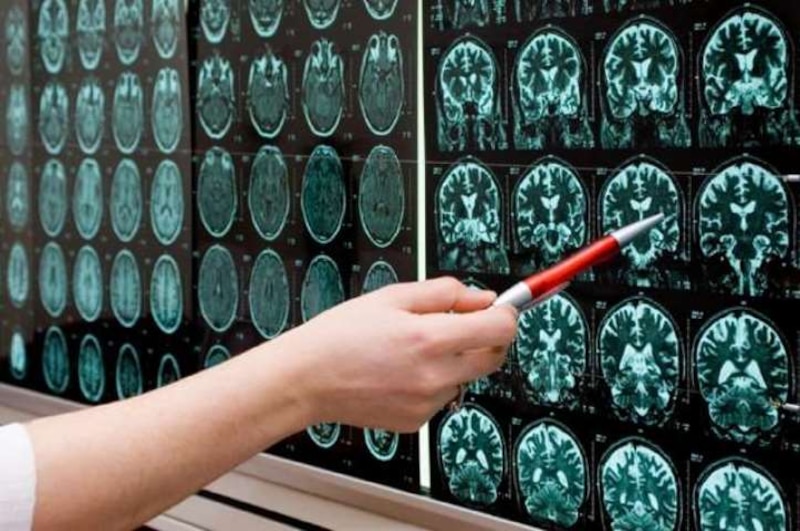 Resonancia magnética del cerebro