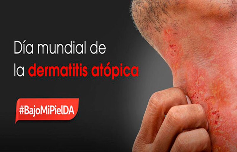 Día mundial de la dermatitis atópica