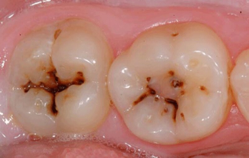 Caries dental