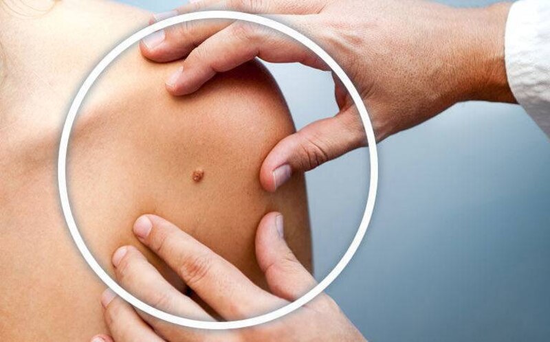 Lunares: ¿cómo saber si son cancerosos?