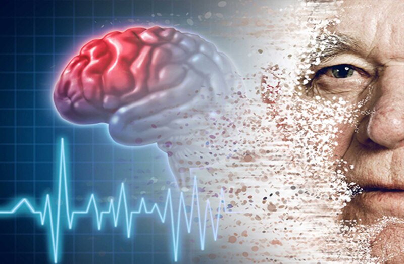 La enfermedad de Alzheimer