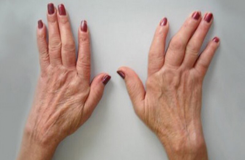 Manos de mujer mostrando signos de artritis reumatoide