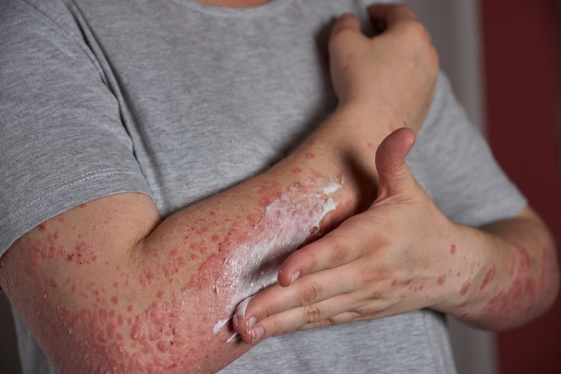 Psoriasis: ¿Qué es y cómo se trata?