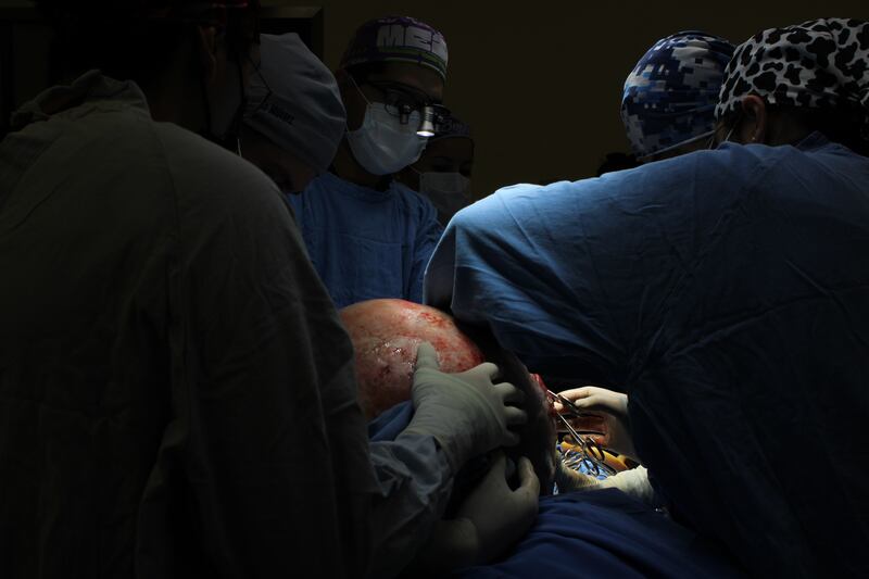 Mujer derechohabiente del IMSS, presentó un tumor de más de 22 kilos, mismo que fue retirado con éxito por especialistas del Seguro Social en Querétaro