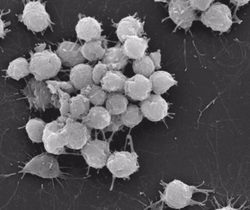 "Imagen de microscopio electrónico de barrido de células cancerosas"