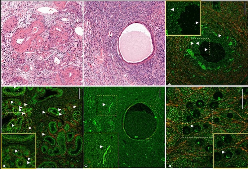 Inmunohistoquímica de cáncer de mama