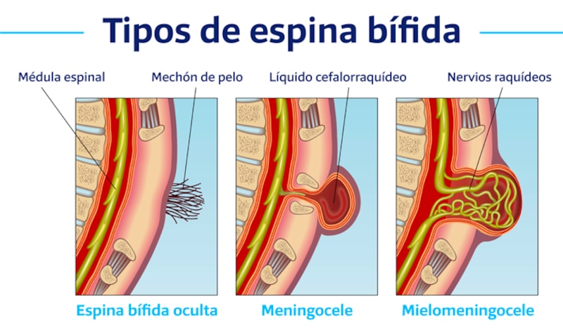 Tipos de espina bífida