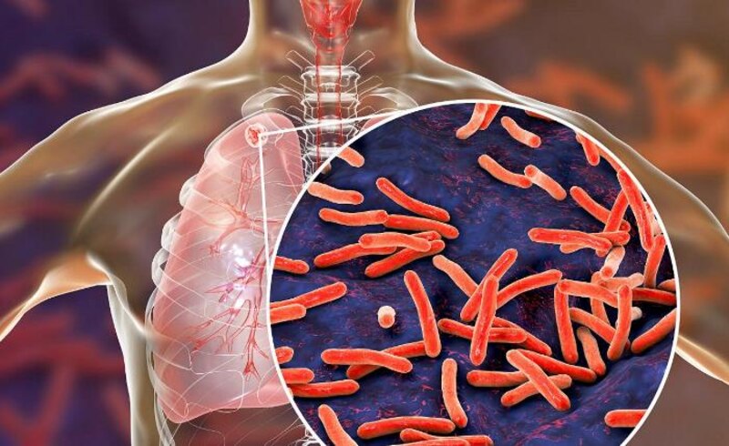 Neumonía bacteriana
