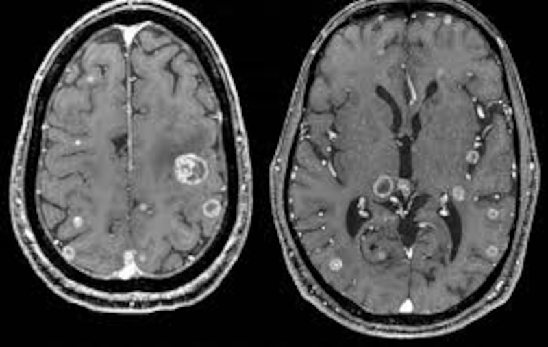 Resonancia magnética del cerebro