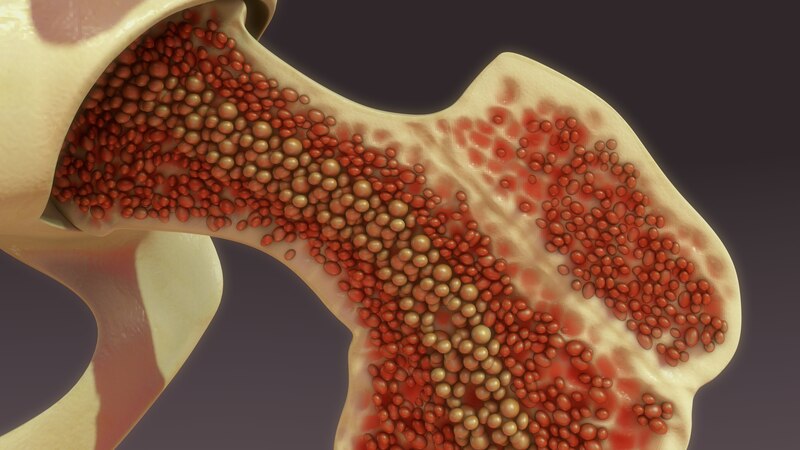 Osteoporosis