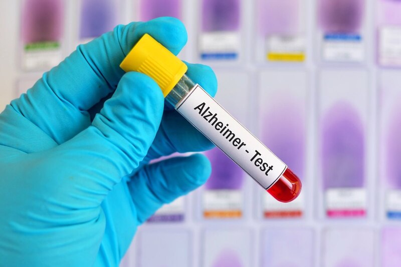 Prueba de Alzheimer