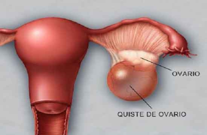 Quiste de ovario