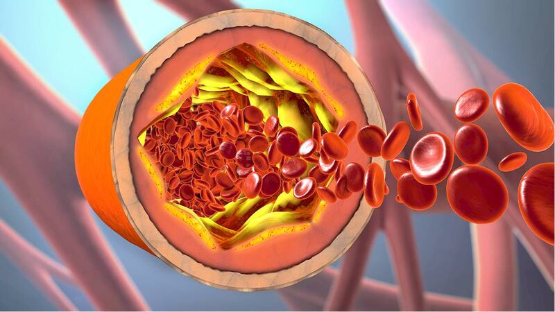 Aterosclerosis