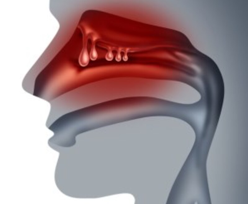 Congestión nasal