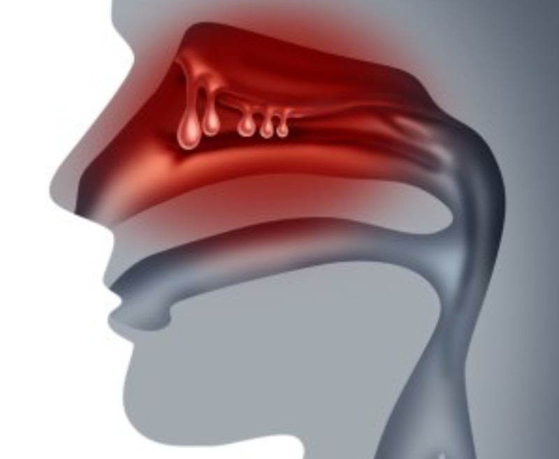 Congestión nasal