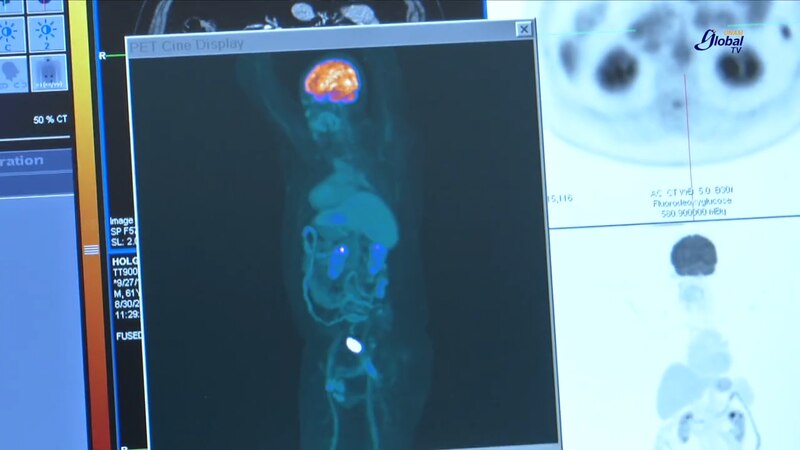 PET scan muestra la propagación del cáncer