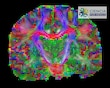 Escudriñan el cerebro con  matemáticas, algoritmos e IA 