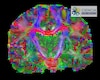 Escudriñan el cerebro con  matemáticas, algoritmos e IA 