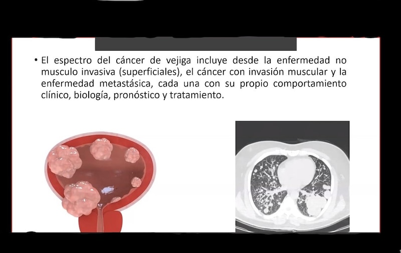 Cáncer de vejiga