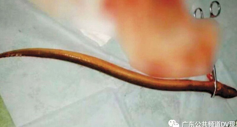 Gusano parásito extraído del cuerpo humano