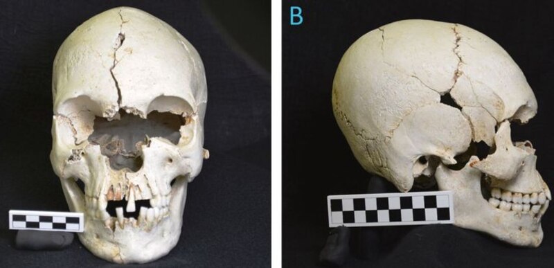 Cráneo humano con fracturas