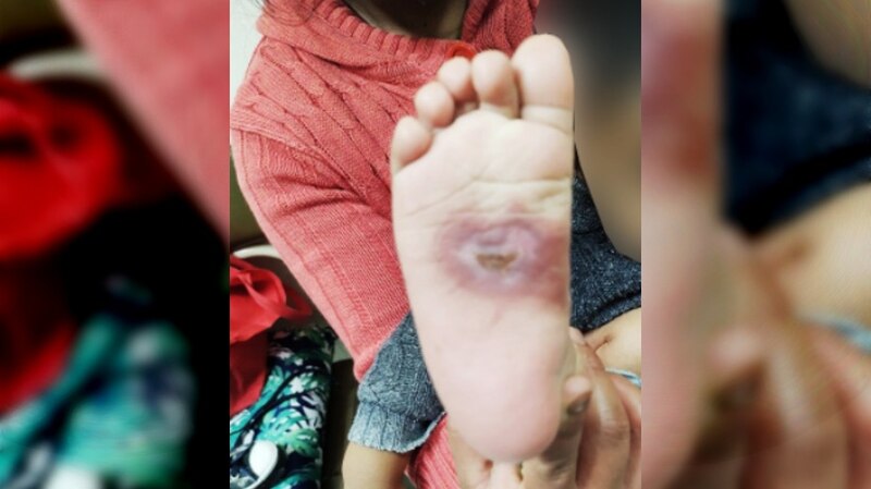 Úlceras en los pies diabéticos