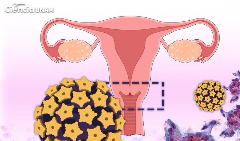 Virus del papiloma humano (VPH)