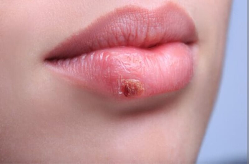 Herpes labial: síntomas, causas y tratamiento