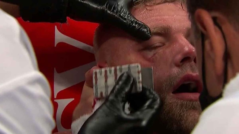 Boxeador con el ojo cortado