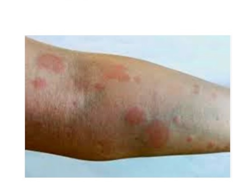 Psoriasis