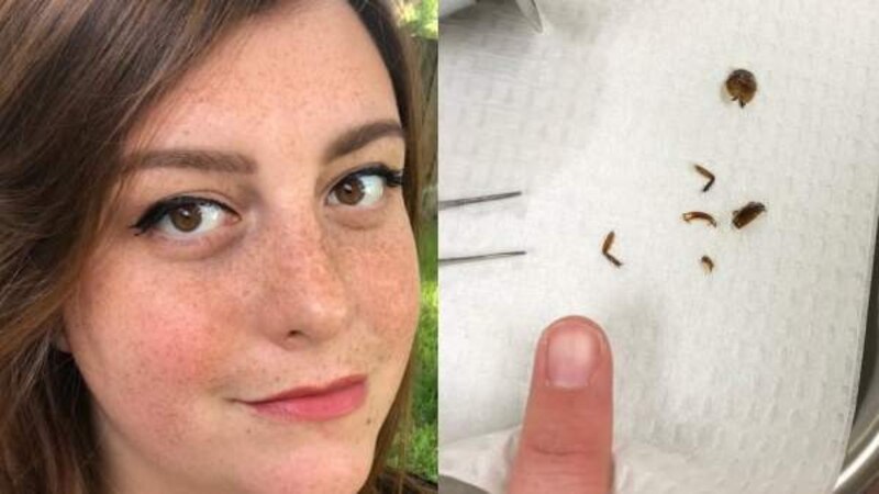 Mujer muestra los dientes de insecto que le sacaron de la oreja