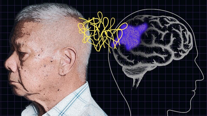La enfermedad de Alzheimer