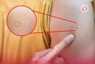 ¿La vacuna que deja cicatriz en el brazo es del sarampión?